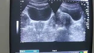 Normal Anatomy of Female Pelvis Ultrasound . Ultrasound urinary bladder.Prevoid Urine Volume