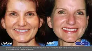 Before and After Photos, Liquid BioCell