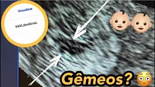 SUSPEITA DE GÊMEOS NA PRIMEIRA ULTRA E BETA HCG ALTO