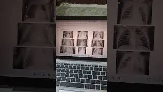 Diagnosing Pneumonia on Chest X-Rays( In a Simple Method)