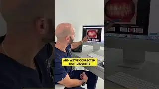 Not all underbites need jaw surgery. We fixed this one with Invisalign only.