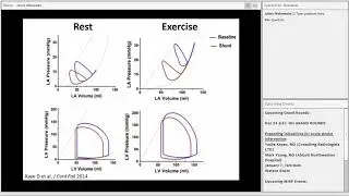 Peter Eckman Paul Sorajja - The Intersection of Heart Failure and Structural Cardiology - 12/17/2018