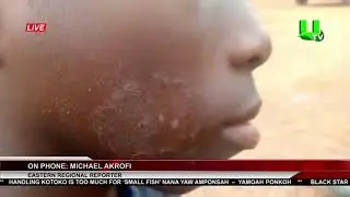 Polluted Source Of Drinking Water Cause Of Strange Skin Diseases