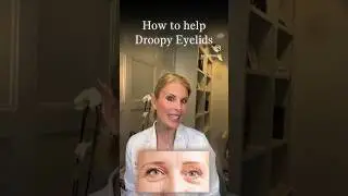 How to solve droopy eyelids. #botox #skincare #filler #beauty