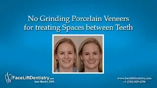 No Grinding Porcelain Veneers for treating Spaces between Teeth