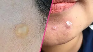 Cosrx vs Nexcare Pimple Patch: Which Is More Effective? (2024)