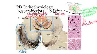 Parkinson's Disease Pathophysiology