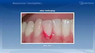 Gingivitt | Blødning i tannkjøttet - Tanntunet Tannhelsesenter