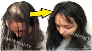 only 2 powerful ingredients🌿, and your hair will grow extremely fast