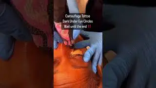 Camouflage Tattoo Dallas Texas #skincare #cosmetictattoo #stretchmarkcamouflage