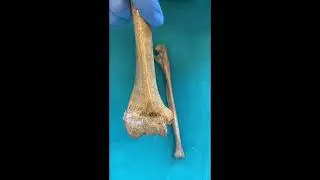 bones of the upper limb radius, ulna, bones of hand