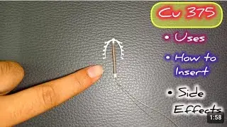 Cu T 375 | Complete Details | Uses, Insertion Procedure, Benefits & Side Effects | Contracptive 