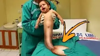 Beb&ecirc; Nasce Com Cauda de Sereia Em Caso Mortal e Espanta Medicina!