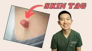 Thinking of removing a skin tag? Watch this first!