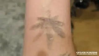 Complete healing process after 5th Laser Tattoo Removal session