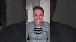 Male Botox Results - Male Botox Before and After - Male Botox Near Me