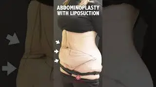 Abdominoplasty with Liposuction - Before & After