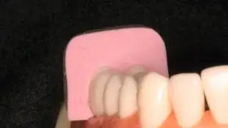 Occlusal Index