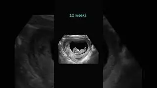 Sneak Peek: 10 Weeks Pregnancy Ultrasound! #baby #ultrasound #positivebirth #pregnant  #babyscan