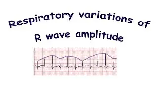 Respiratory variations of R wave amplitude