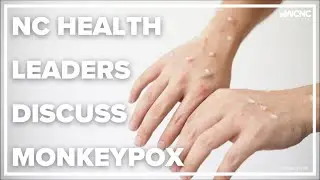 NC health leaders discuss monkeypox
