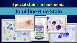 Toluidine blue(Special stain in leukaemia).