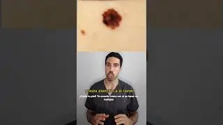 DERMAT&Oacute;LOGO explica C&Oacute;MO detectar el MELANOMA. Evita el CANCER DE PIEL! Revisa tus lunares