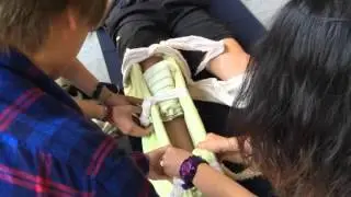 小腿骨折固定第二組