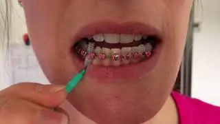 How to clean your teeth when you have Fastbraces