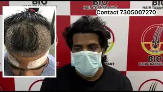 1.5 years hair transplant results (before after) #hairtransplantchennai