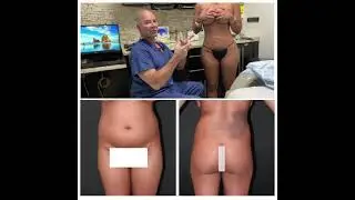 Liposuction & BBL - Makeover by Doctor Mendieta