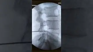 Fluoroscopic View of Percutaneous Disk Decompression Procedure