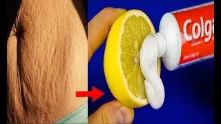 How To Get Rid of Stretch Marks Fast/World's best Remedy for Fast Stretch mark Removing