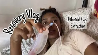 1WK POST OP VLOG| Pilonidal Cyst Extraction Surgery