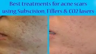 Subscision, Fillers & CO2 Laser To Treat Acne Scars | The Esthetic Clinics, India