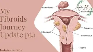 My Fibroids Journey Update pt.1 | Cultivating Inner Beauty