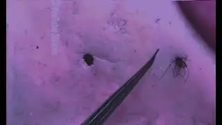 Removal of ingrown hair #844