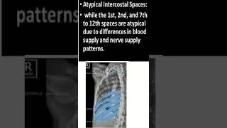 How to identify intercostal spaces in Chest X ray #shorts #chestradiograph