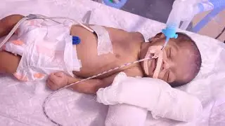 NICU New born baby care unit neonatal intensive care unit critical condition CPAP machine ventilator