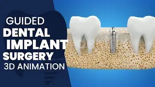 Dentfix | Guided Dental Implant Surgery 3D Animation
