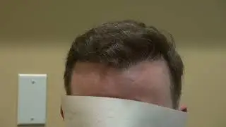 Natural Results of Hair Restoration Treatment for Male Patient