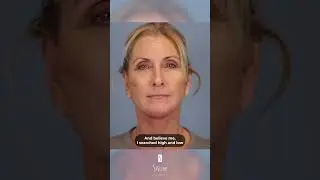 Was THIS Surgery Worth It? Deep Plane Facelift and Deep Neck Lift