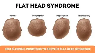 Best Sleeping Positions to Prevent Flat Head Syndrome in Babies