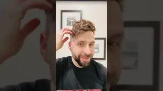 From thinning to winning: Your journey starts here with Lordhair #hairstyle  #hairloss