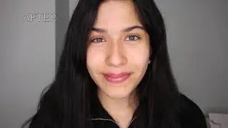 Eye Color Change from Dark Brown to Emerald Green with Kerato