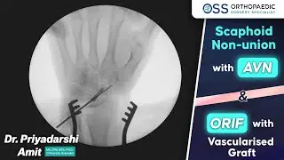 Scaphoid Fracture Non-union & AVN | ORIF with Vascularized Graft by Dr. Priyadarshi Amit