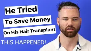 He Had Hair Transplant Surgery In Turkey To Save Money - This Happened