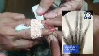 Buddy strapping Fingers | Finger injuries | PIP joint Finger injury treatment | Adamya Hospital Vid