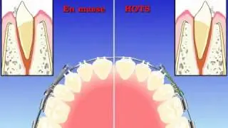 [HOTS] Comparison of Anterior Reraction [En masse]
