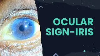 Ocular sign - iris